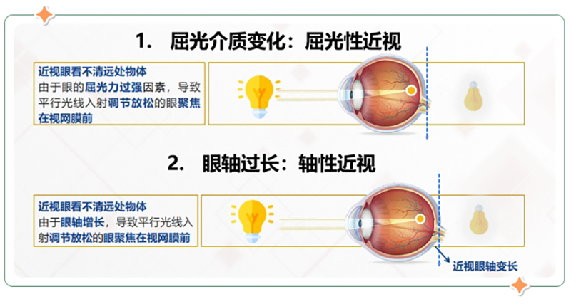 近视.png